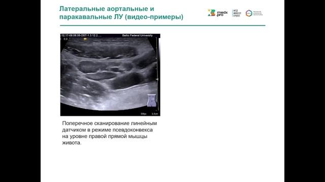Лимфатические узлы брюшной полости. Часть 2. Париетальные лимфатические узлы. 2022 08 12 12 25 0 смотреть онлайн