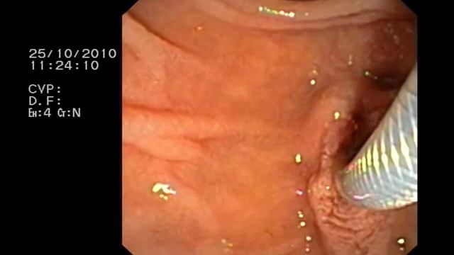 Проводник из нитинола MTW-Endoskopie смотреть онлайн