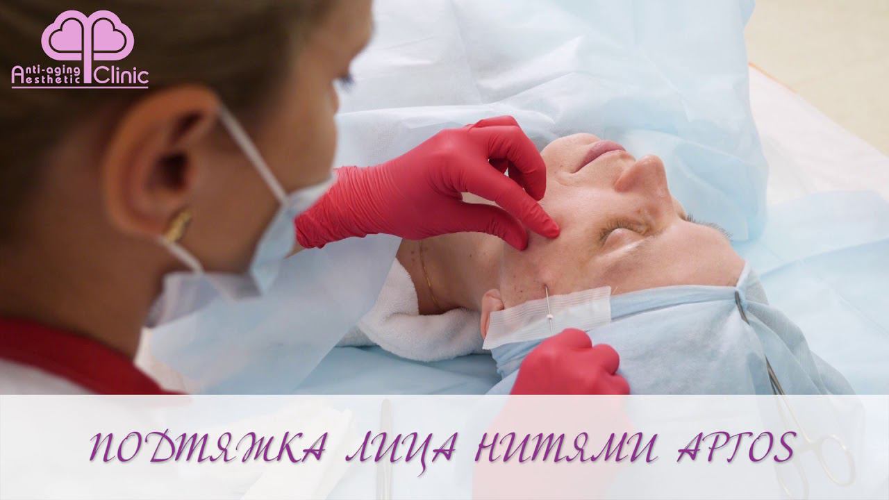 Нитевой лифтинг нитями Aptos Москва. А клиника. смотреть онлайн