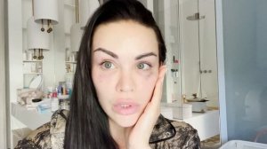 ИГОЛЬЧАТЫЙ RF ЛИФТИНГ. МОИ РЕЗУЛЬТАТЫ. КАК УБРАТЬ МОРЩИНЫ ВОКРУГ ГЛАЗ?