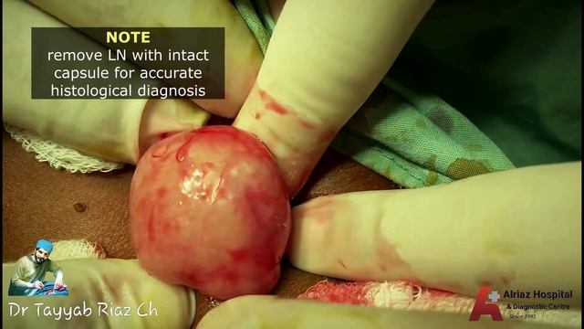 Cervical Lymph Node Excision Biopsy | Step by Step - Dr Tayyab Riaz Ch смотреть онлайн