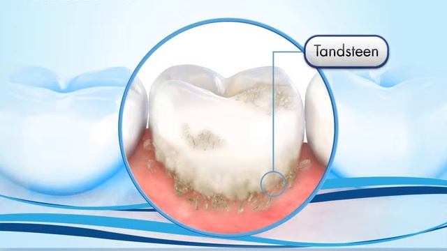 Oral-B | Tandsteen - Oorzaken en behandeling смотреть онлайн
