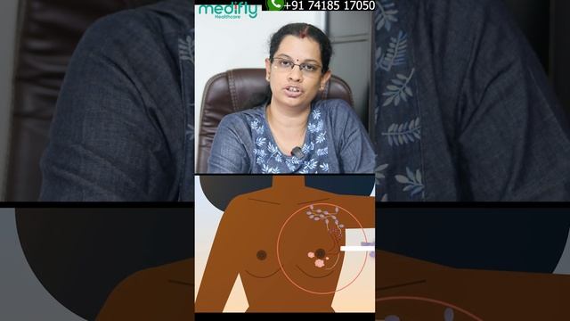 Axillary Surgery for Breast Cancer: Comprehensive Guide and Recovery Tips смотреть онлайн