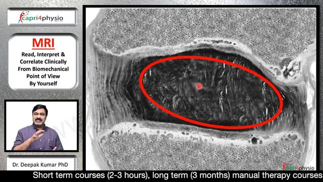 How to Read MRI Film of Spine, Understand, Pick Relevant Findings, Interpret & Correlate Clinically смотреть онлайн