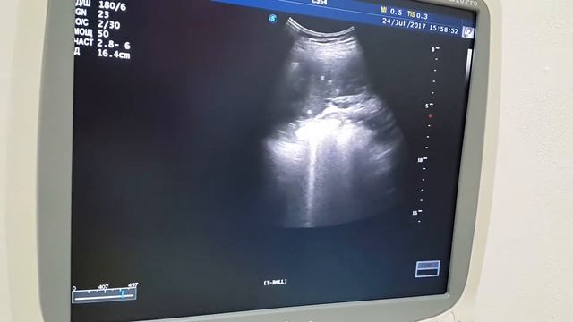Множественные кальцинаты селезенки смотреть онлайн