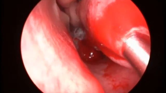 Шейверная подслизистая редукция нижних раковин (microdebrider-assisted turbinoplasty)