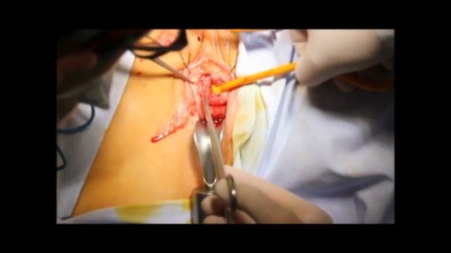 Реконструкция женской уретры смотреть онлайн
