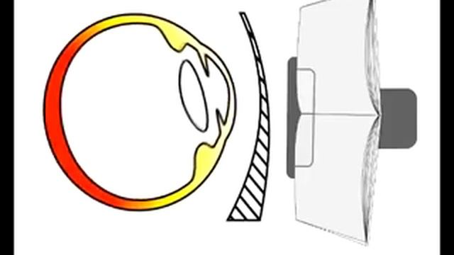PERIFOCAL Инновационная линза Anlauf для тренировки аккомодации смотреть онлайн