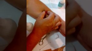 Удаление фурункула самостоятельно