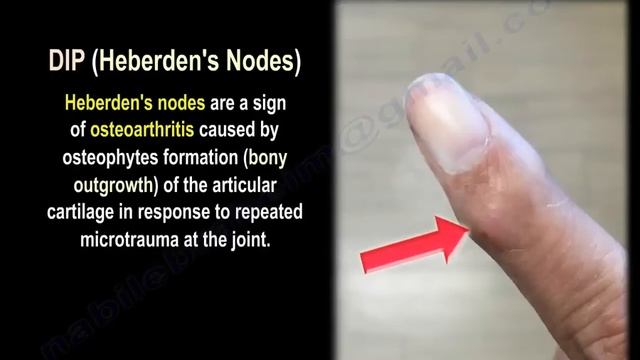 Osteoarthritis Of The Fingers Heberden's Nodes - Everything You Need To Know - Dr. Nabil Ebraheim смотреть онлайн