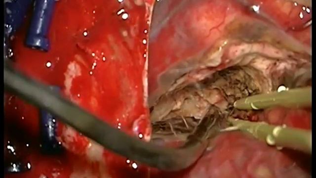 Microsurgical resection of a left parietal AVM смотреть онлайн