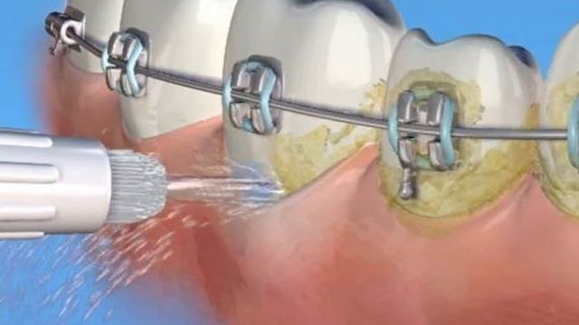 Как выбрать ирригатор для рта смотреть онлайн