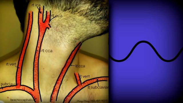 Carotid Duplex Exam