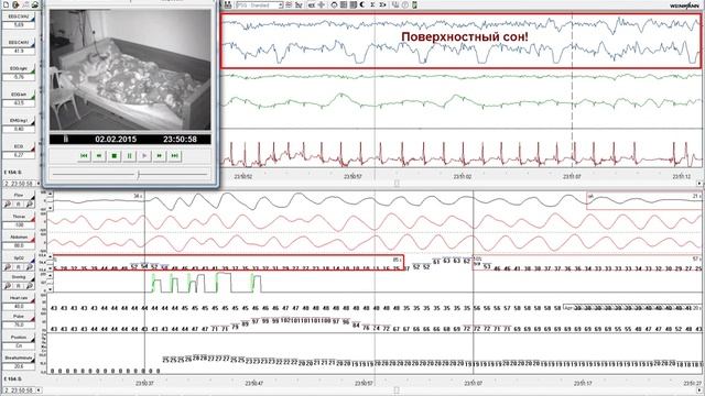 Как выглядит полисомнография ? УкрТелеМед Лаборатория сна смотреть онлайн