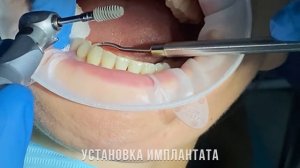 ИМПЛАНТАЦИЯ. Установка дентального имлантата в области 46 зуба.