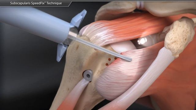 Subscapularis SpeedFix™ Technique смотреть онлайн