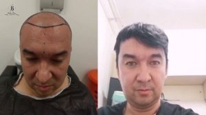 Пересадка волос до и после / отзыв Анатолия