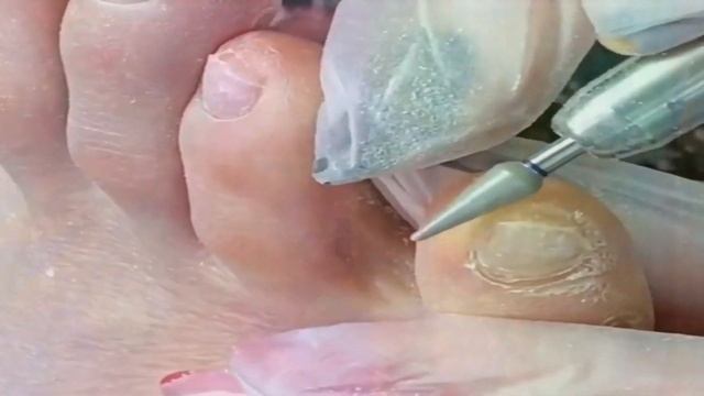VLOG INGROWN DRY SKIN REMOVAL TOENAIL @trendsusa90