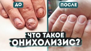 ПОЧЕМУ ОТСЛАИВАЮТСЯ НОГТИ? Как лечить онихолизис? Мнение подолога.