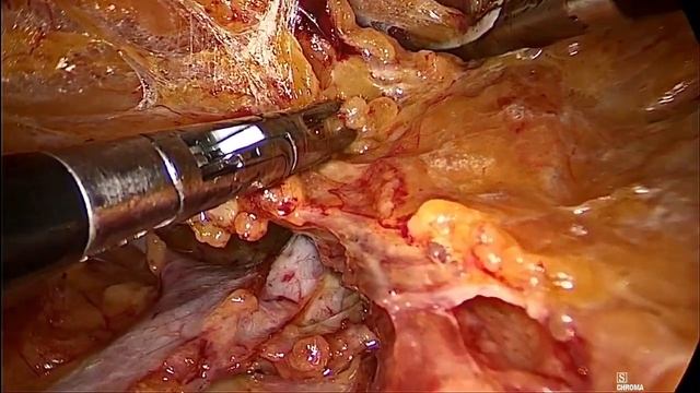 Fluorescence-guided Video-endoscopic Inguinal Lymph node dissection (VEIL) смотреть онлайн