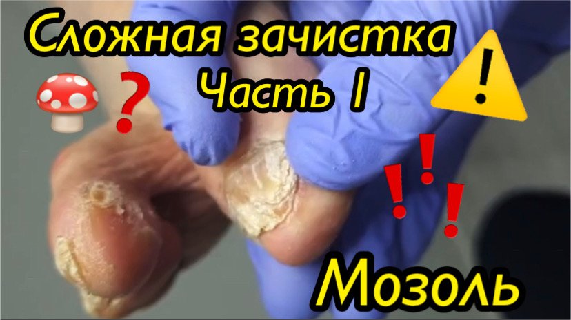 Сложная зачистка ногтей??⚠️??? • Мозоль? • Часть 1 смотреть онлайн