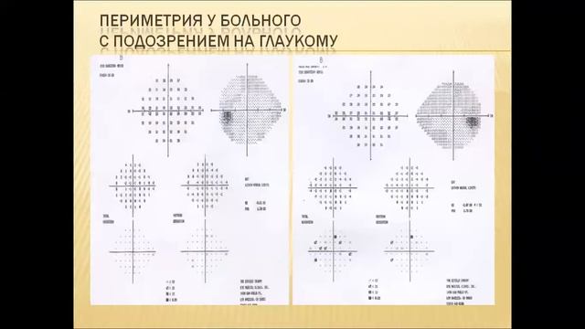 Лекция глаукома