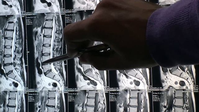 Learn to Read MRI of Slip Disc-How to read MRI of Lumbar Spine disc bulge-Herniated Disc MRI L4-L5 смотреть онлайн