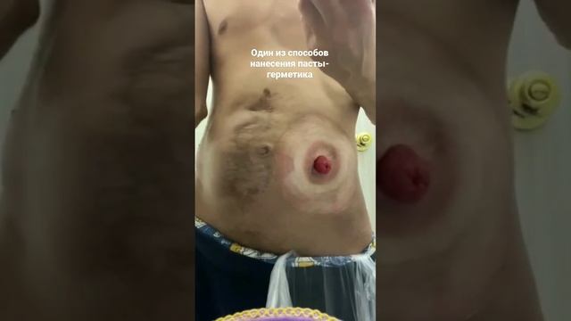 Паста герметик coloplast один из способов нанесения на пластину стома смотреть онлайн