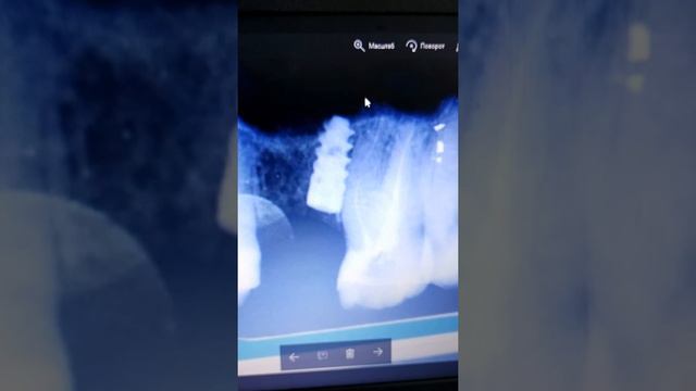 Имплантологическая травма зуба.Разбор клинического случая смотреть онлайн