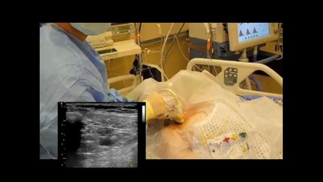 Катетеризация подключичной вены под контролем УЗИ