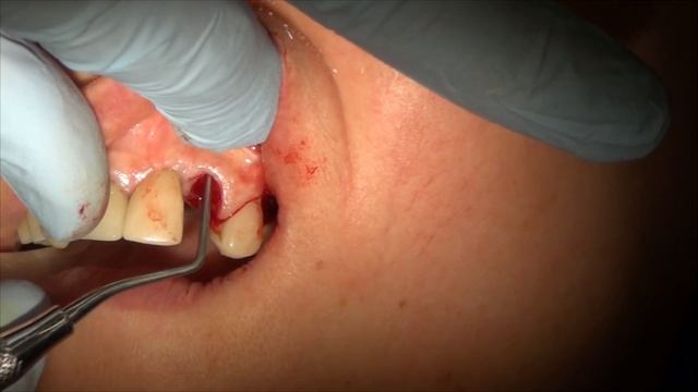 extraction, implant ,bone graft ,temporary crown,sinus lift смотреть онлайн