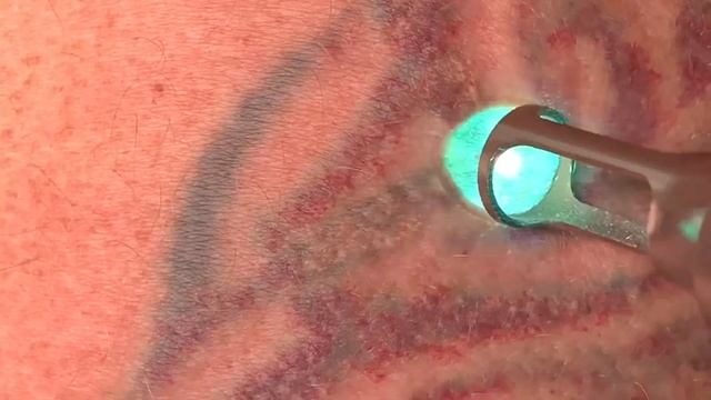 Удаление татуировки лазером. Видео процесса. смотреть онлайн