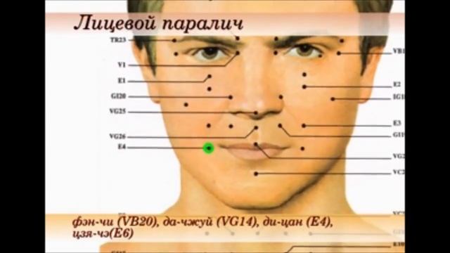 точки при невралгии тройничного нерва и лицевом параличе(секрет исюэтуна) смотреть онлайн