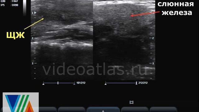 Диффузные изменения щитовидной железы. Еще один пример. смотреть онлайн
