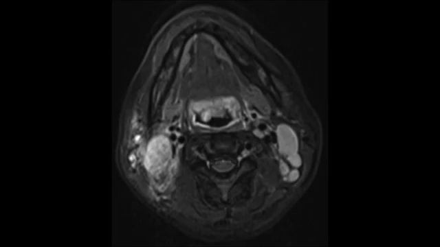 Tuberculous Tonsillitis and Tuberculoma смотреть онлайн
