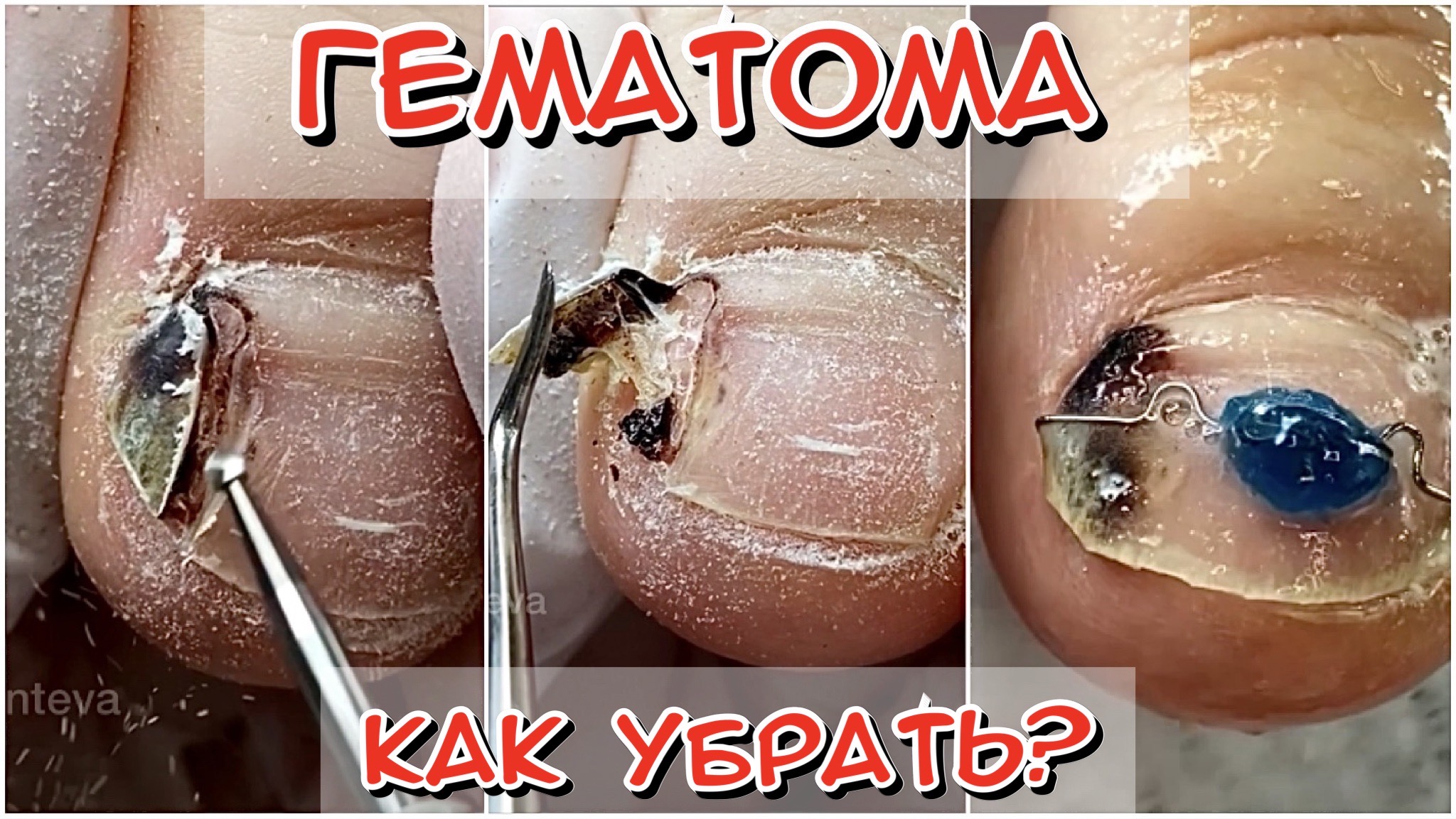 Гематома - как убрать? смотреть онлайн