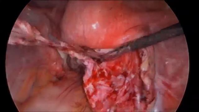 Эндометриоидная киста яичника хирургическое лечение смотреть онлайн
