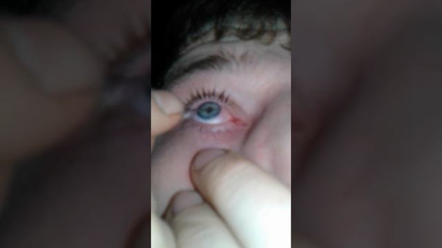 Удаление занозы из глаза смотреть онлайн