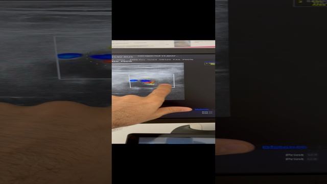 Лечение тромбоза без операции. Узи сосудов. Флеболог Москва смотреть онлайн