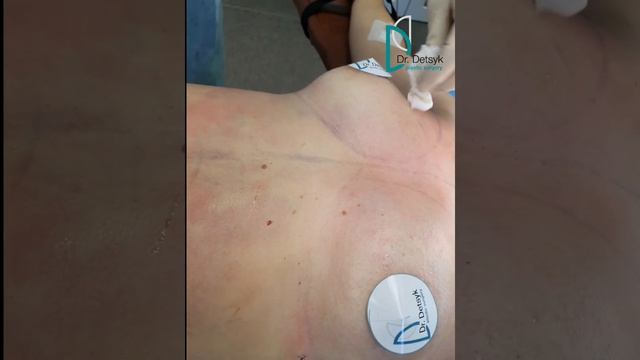 Липофилинг груди - коррекция формы и объёма груди собственным жиром. смотреть онлайн