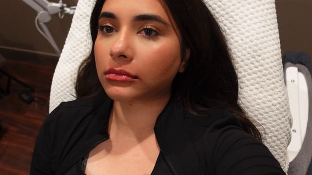 I GOT LIP FILLERS FOR THE FIRST TIME! - 1ML