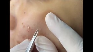 Удаление черных точек 2021 - Remoção de cravo 2021 - Pimple Popping 2021 -Blackhead Removal 2021