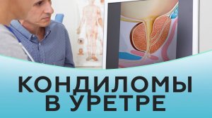 Кондиломы в уретре.