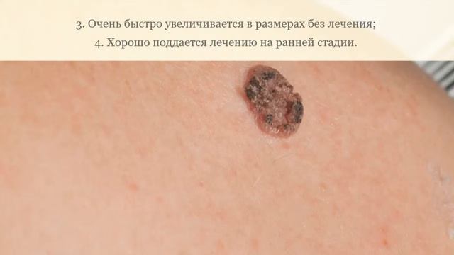 Как распознать у себя рак кожи на ранней стадии? смотреть онлайн
