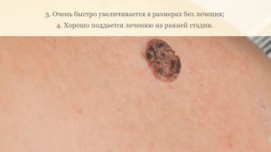 Как распознать у себя рак кожи на ранней стадии?