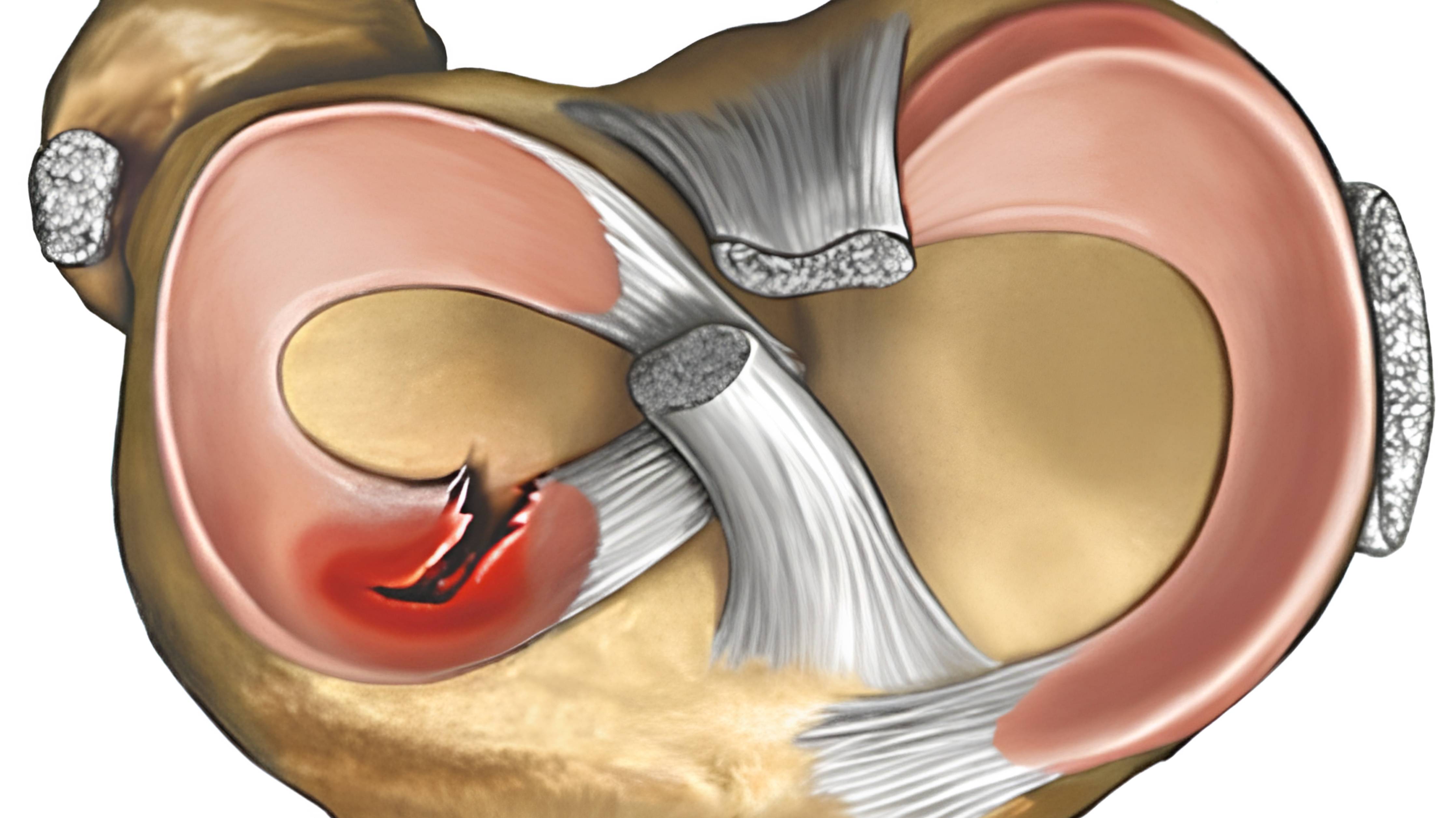 Разрыв мениска