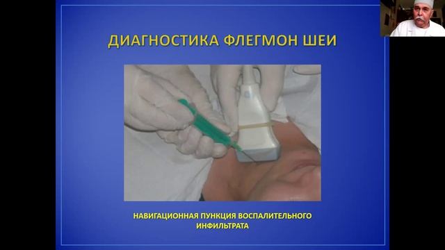 Глубокие флегмоны шеи смотреть онлайн