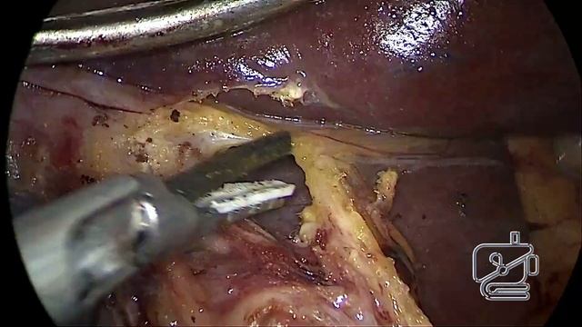 Korean Style D2 Lymph Node Dissection During Gastrectomy смотреть онлайн