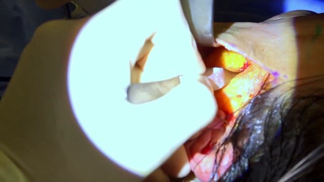PART 4: The Facelift SMAS Elevation Technique | Real Plastic Surgery with Dr. Buonassisi смотреть онлайн