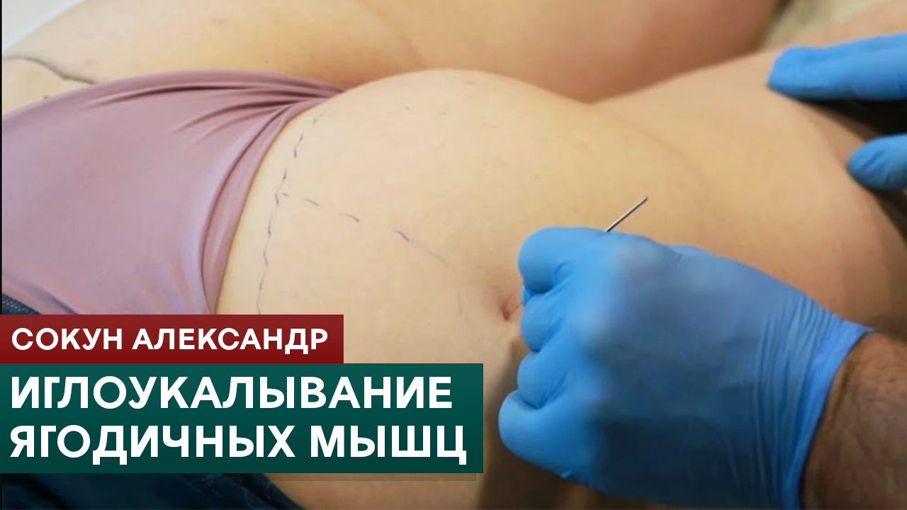 Иглоукалывание ягодичных мышц. Триггерные точки. Метод сухой иглы. Сокун Александр смотреть онлайн